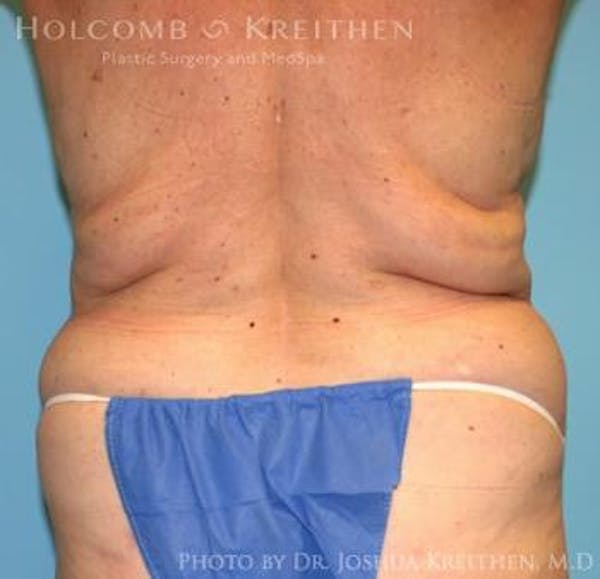 Liposuction Before & After Gallery - Patient 6236518 - Image 5