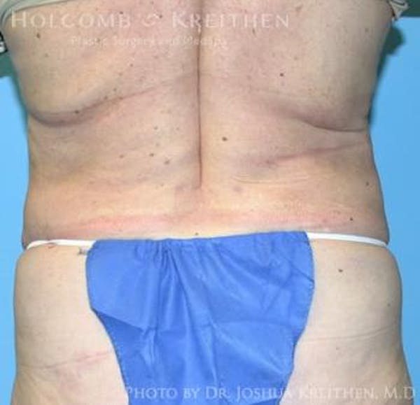 Liposuction Gallery - Patient 6236518 - Image 6