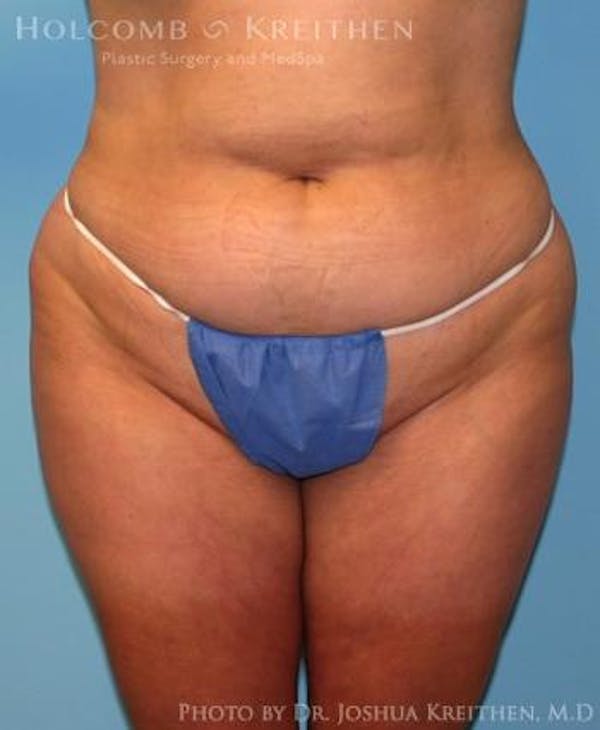 Liposuction Before & After Gallery - Patient 6236523 - Image 1