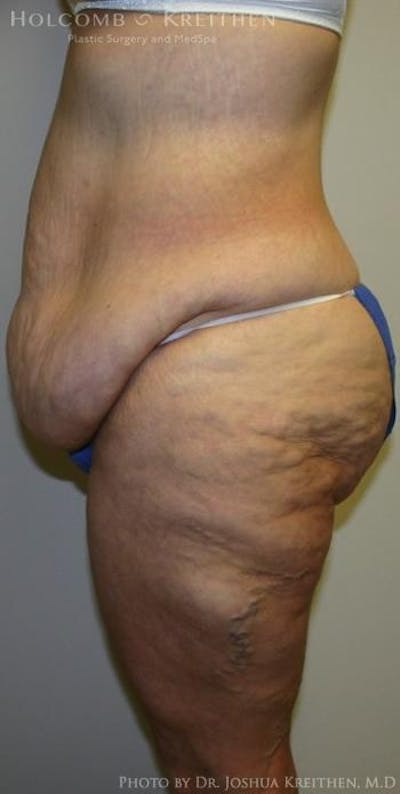 Lower Body Lift Before & After Gallery - Patient 6236521 - Image 1