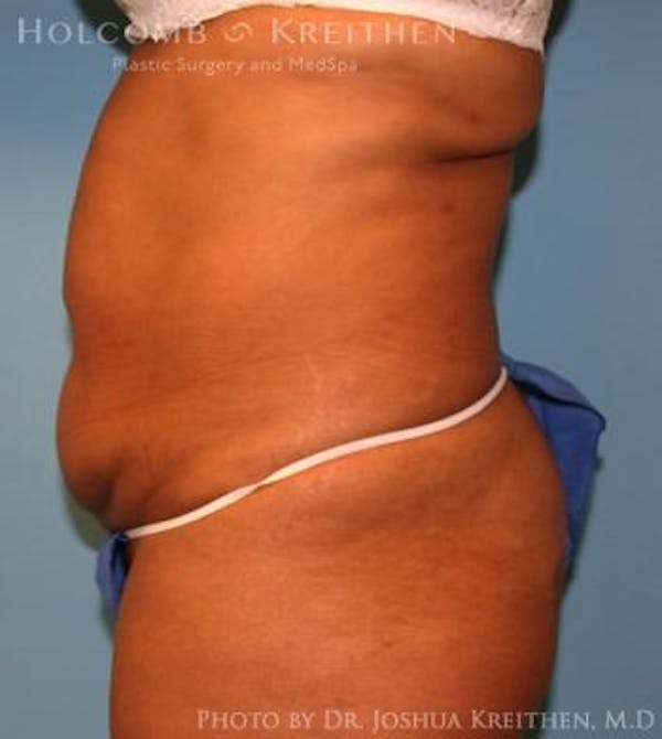 Mini Abdominoplasty Before & After Gallery - Patient 6236520 - Image 3
