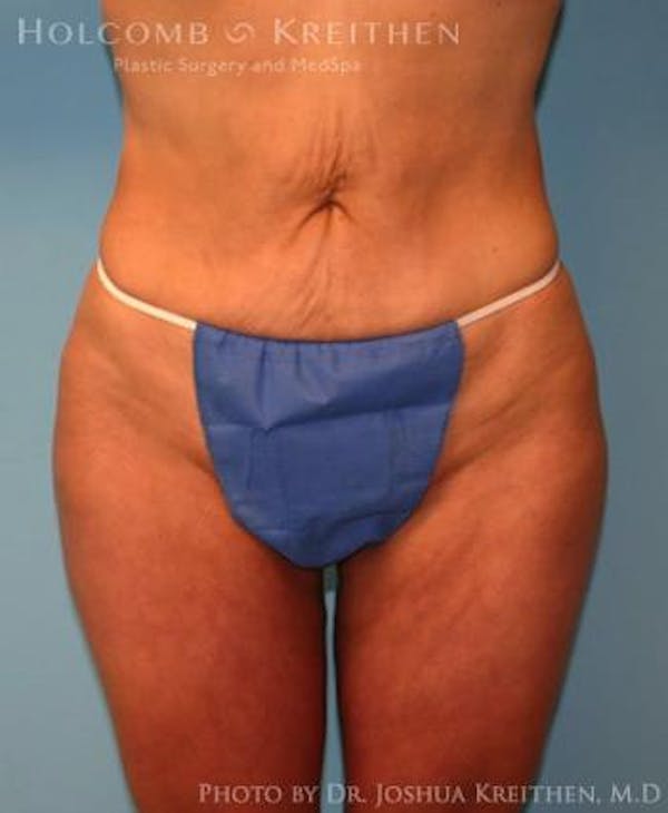 Liposuction Before & After Gallery - Patient 6236523 - Image 2
