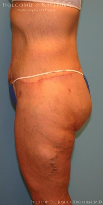 Lower Body Lift Before & After Gallery - Patient 6236521 - Image 2