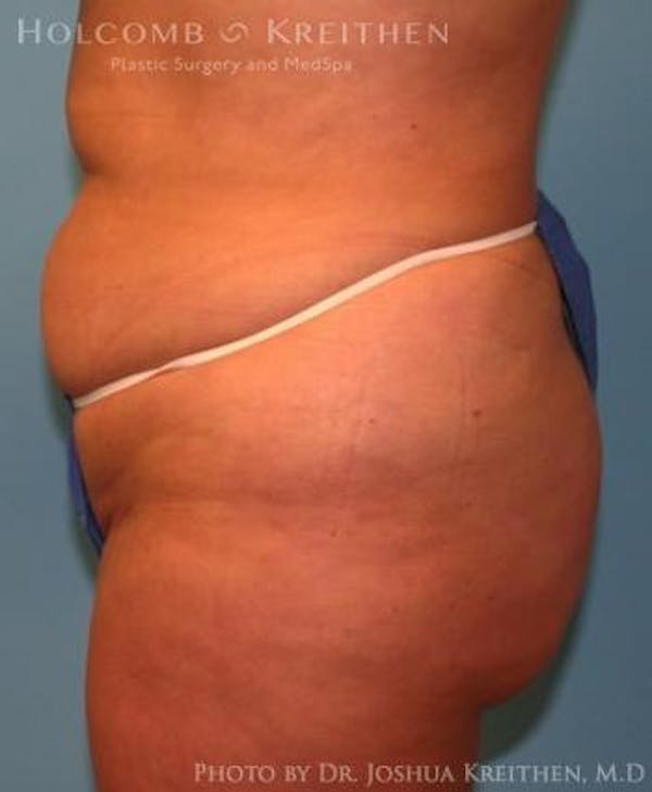 Liposuction Before & After Gallery - Patient 6236523 - Image 3