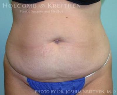 Mini Abdominoplasty Before & After Gallery - Patient 6236524 - Image 1