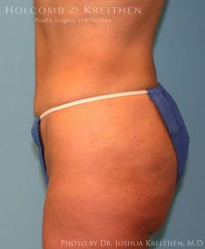 Liposuction Before & After Gallery - Patient 6236523 - Image 4