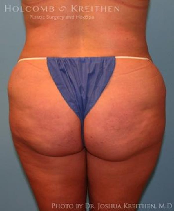 Liposuction Before & After Gallery - Patient 6236523 - Image 5