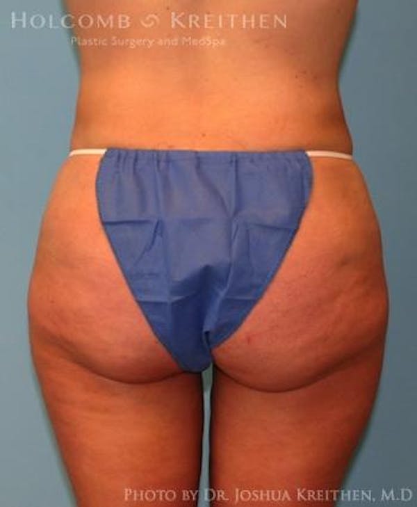 Liposuction Before & After Gallery - Patient 6236523 - Image 6