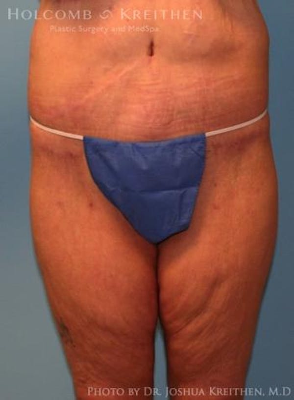 Lower Body Lift Before & After Gallery - Patient 6236525 - Image 2