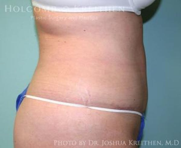 Mini Abdominoplasty Before & After Gallery - Patient 6236524 - Image 4