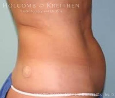 Liposuction Before & After Gallery - Patient 6236526 - Image 1