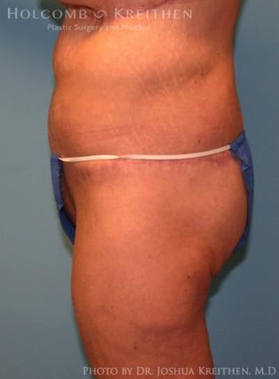 Lower Body Lift Before & After Gallery - Patient 6236525 - Image 4