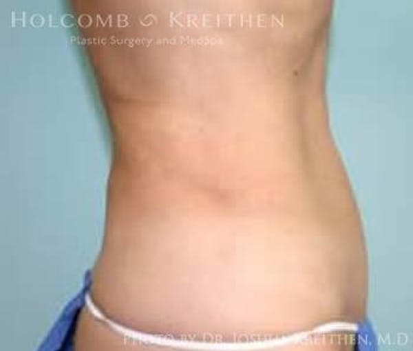 Liposuction Before & After Gallery - Patient 6236526 - Image 2