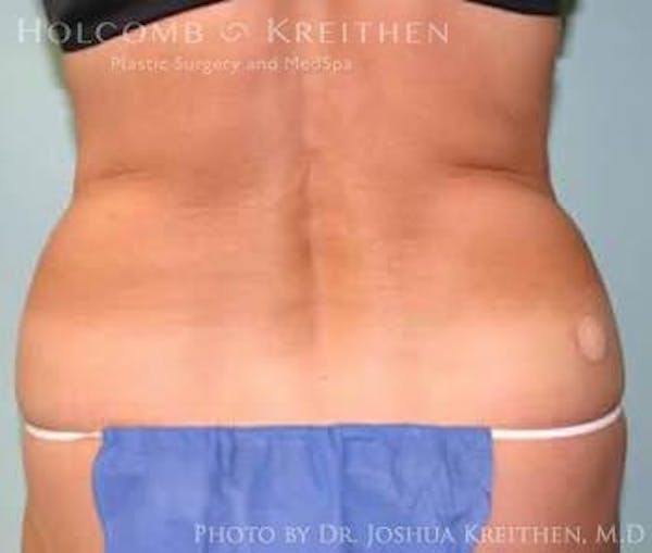 Liposuction Before & After Gallery - Patient 6236526 - Image 3