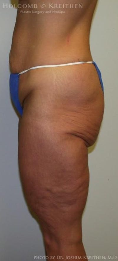 Lower Body Lift Before & After Gallery - Patient 6236527 - Image 1