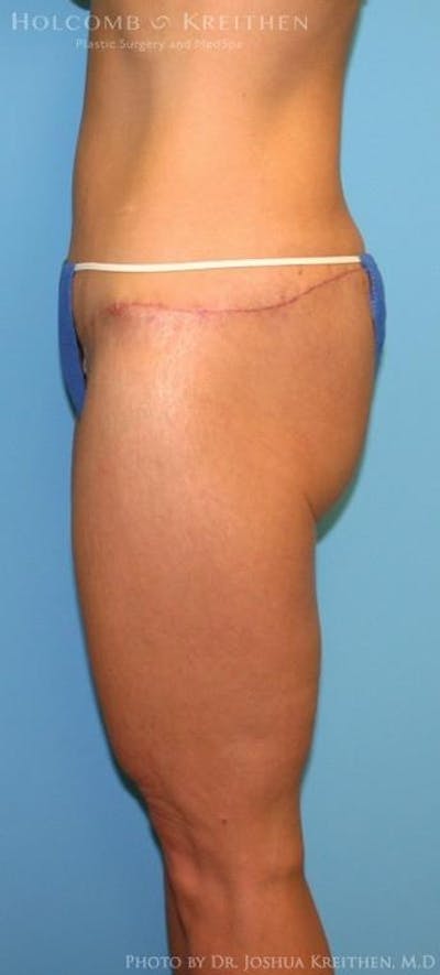 Lower Body Lift Before & After Gallery - Patient 6236527 - Image 2