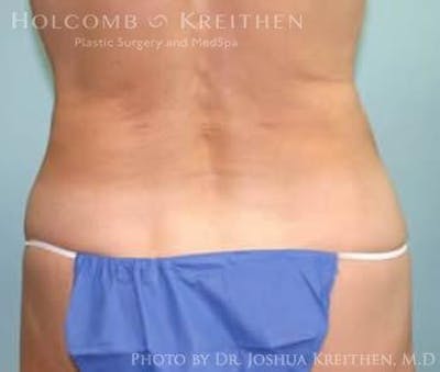 Liposuction Before & After Gallery - Patient 6236526 - Image 4