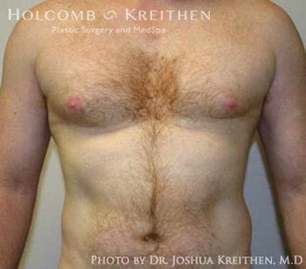 Liposuction Before & After Gallery - Patient 6236530 - Image 1
