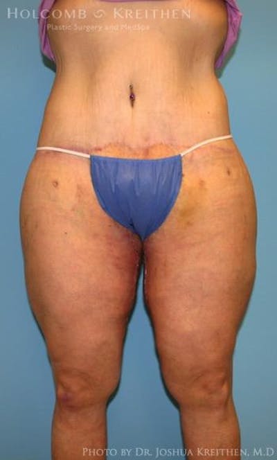 Lower Body Lift Before & After Gallery - Patient 6236528 - Image 2