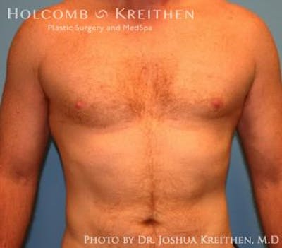 Liposuction Before & After Gallery - Patient 6236530 - Image 2