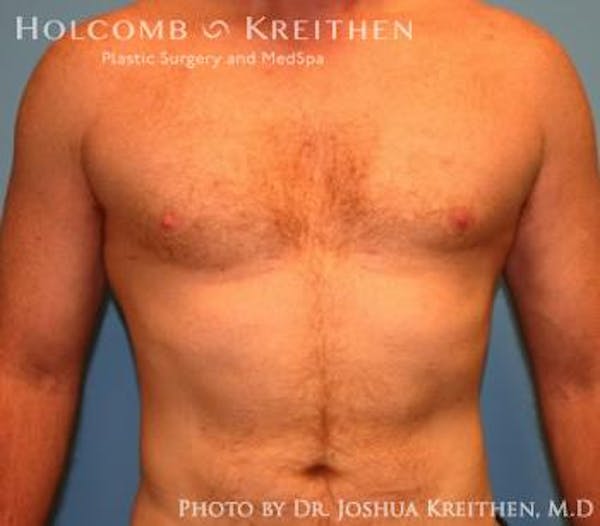 Liposuction Before & After Gallery - Patient 6236530 - Image 2