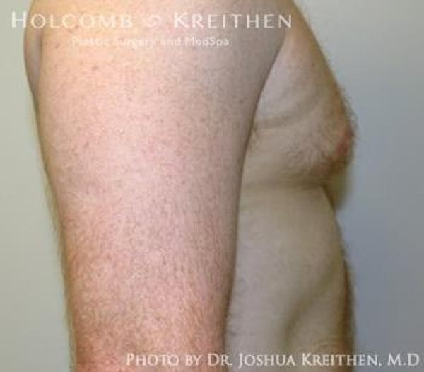 Liposuction Before & After Gallery - Patient 6236530 - Image 3