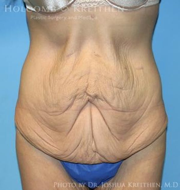Lower Body Lift Before & After Gallery - Patient 6236531 - Image 1