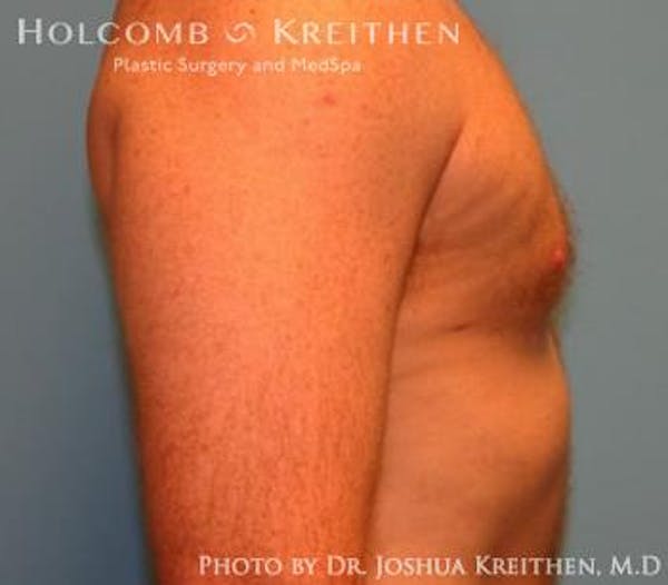 Liposuction Before & After Gallery - Patient 6236530 - Image 4