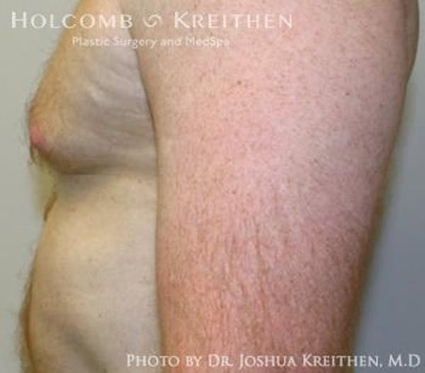 Liposuction Gallery - Patient 6236530 - Image 5