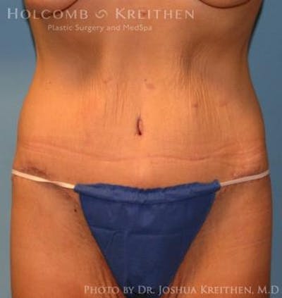 Lower Body Lift Before & After Gallery - Patient 6236531 - Image 2