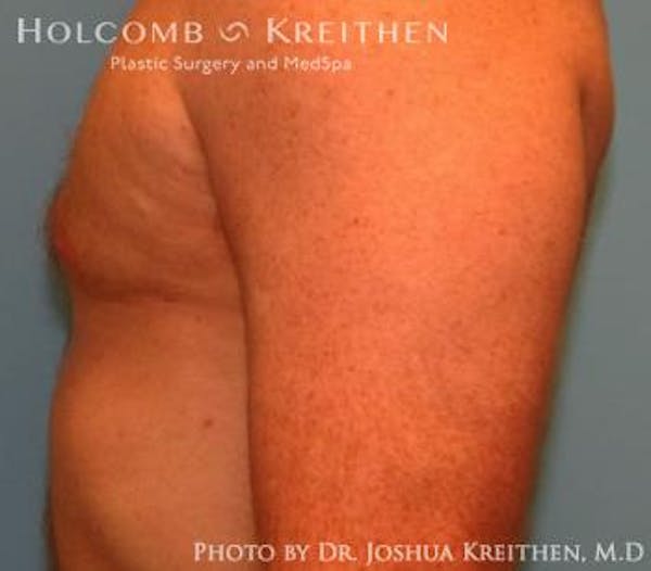 Liposuction Before & After Gallery - Patient 6236530 - Image 6