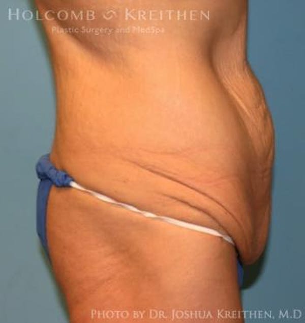 Lower Body Lift Before & After Gallery - Patient 6236531 - Image 3