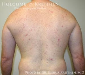 liposuction