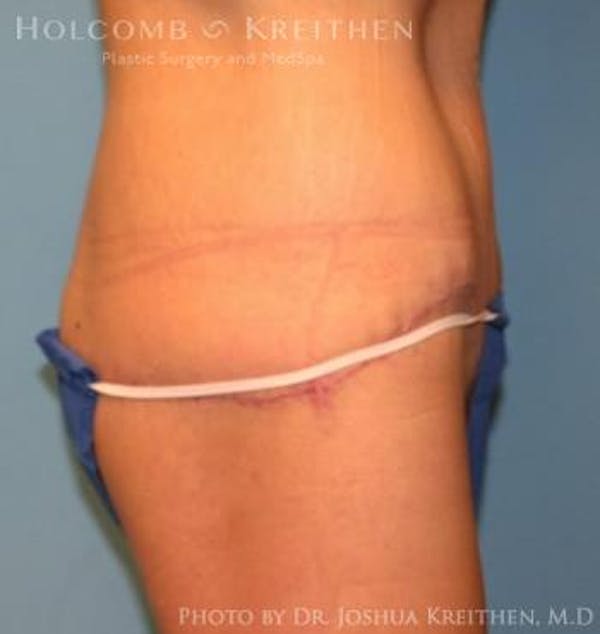 Lower Body Lift Before & After Gallery - Patient 6236531 - Image 4