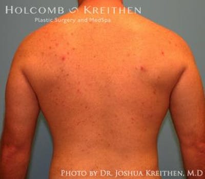 Liposuction Before & After Gallery - Patient 6236530 - Image 8