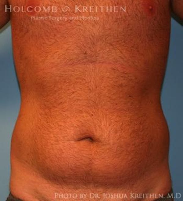 Liposuction Before & After Gallery - Patient 6236534 - Image 1