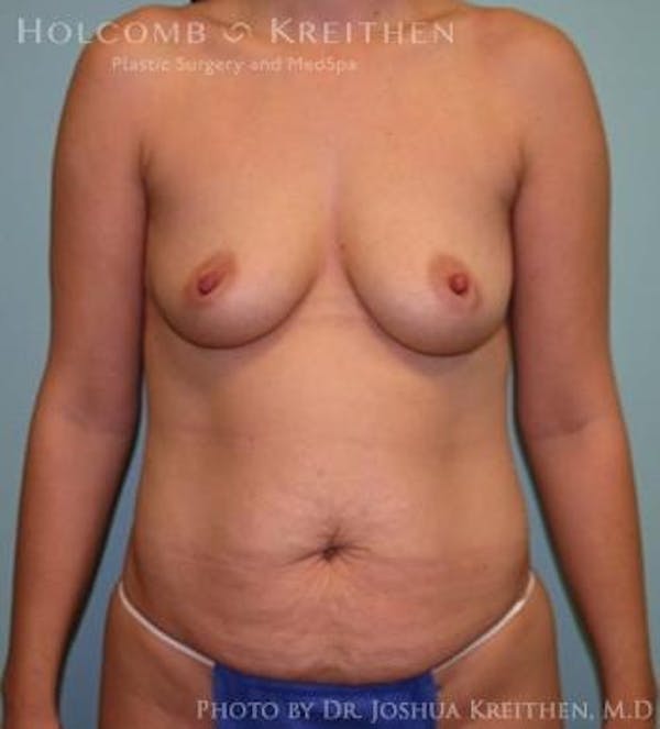 Mommy Makeover Before & After Gallery - Patient 6236532 - Image 1