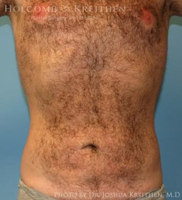 Liposuction Before & After Gallery - Patient 6236534 - Image 2