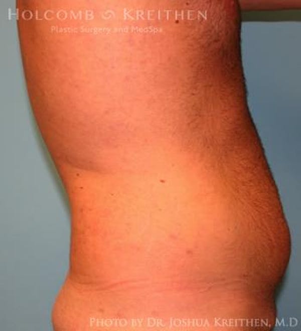 Liposuction Before & After Gallery - Patient 6236534 - Image 3