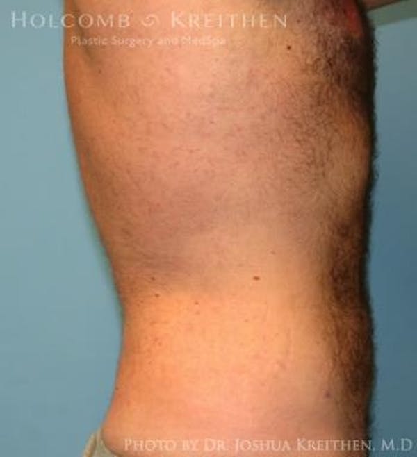 Liposuction Before & After Gallery - Patient 6236534 - Image 4