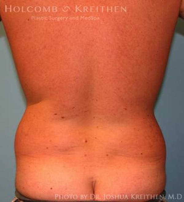 Liposuction Gallery - Patient 6236534 - Image 5