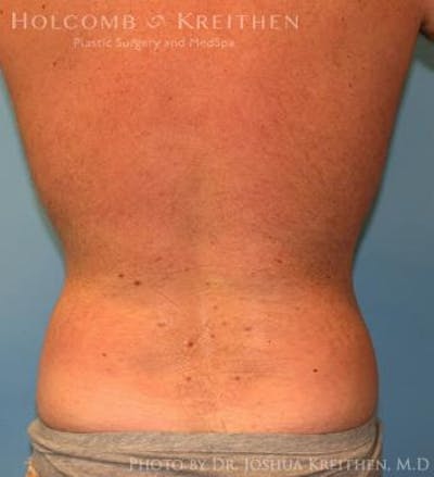 Liposuction Before & After Gallery - Patient 6236534 - Image 6