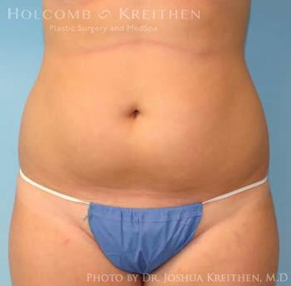 Liposuction Before & After Gallery - Patient 6236537 - Image 1