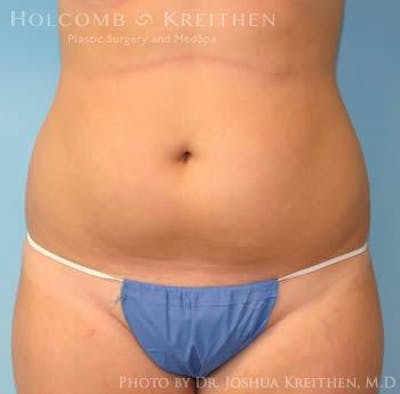 Liposuction Before & After Gallery - Patient 6236537 - Image 1