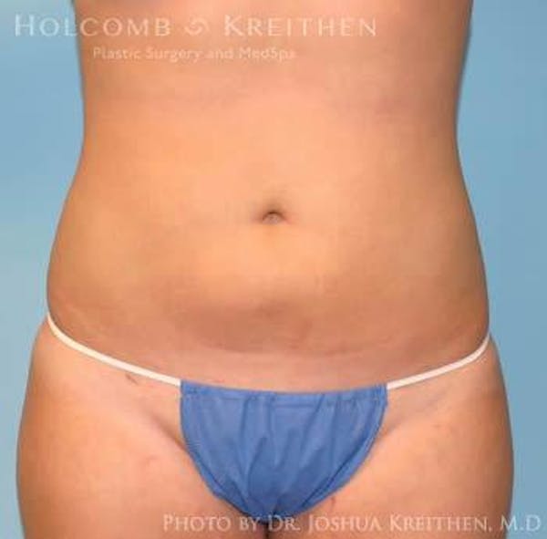 Liposuction Before & After Gallery - Patient 6236537 - Image 2