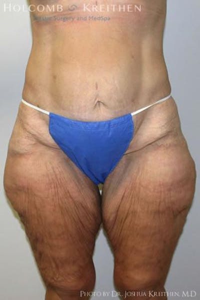 Thigh Lift Before & After Gallery - Patient 6236535 - Image 1