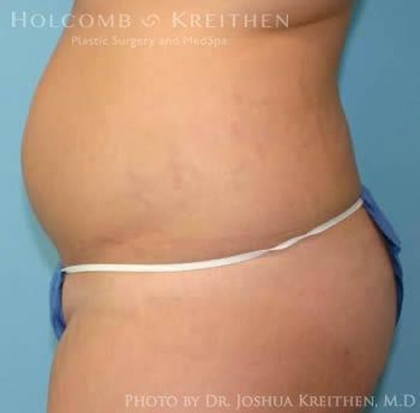 Liposuction Gallery - Patient 6236537 - Image 3