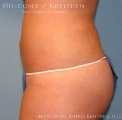 Liposuction Before & After Gallery - Patient 6236537 - Image 4