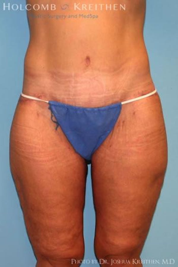 Thigh Lift Before & After Gallery - Patient 6236535 - Image 2