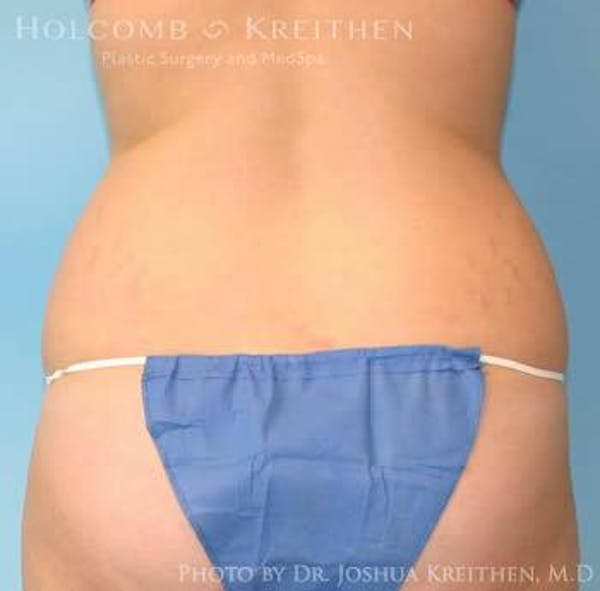 Liposuction Before & After Gallery - Patient 6236537 - Image 5